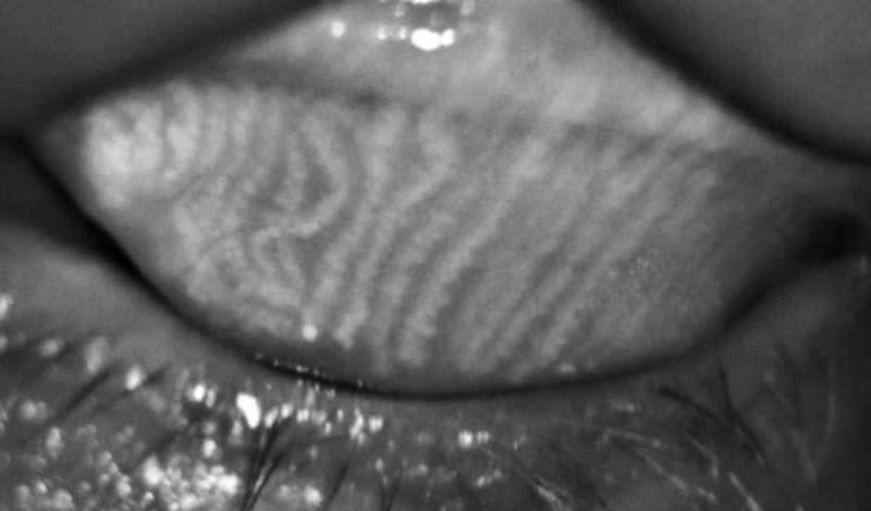 Die Abbildung zeigt die Drüsen an der innen Seite der Augenlider / © Sicca-Ambulanz